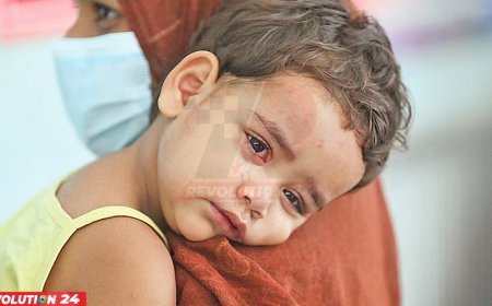 ২০ দিনে হামের উপসর্গে ৯৯ শিশুর মৃত্যু, কাল থেকে ১৮ জেলায় বিশেষ টিকাদান