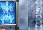 সোনার চেইন চুরি করে গিলে ফেললেন নারী! এক্সরেতে ধরা পড়ল পেটের ভেতর