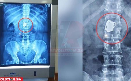 সোনার চেইন চুরি করে গিলে ফেললেন নারী! এক্সরেতে ধরা পড়ল পেটের ভেতর